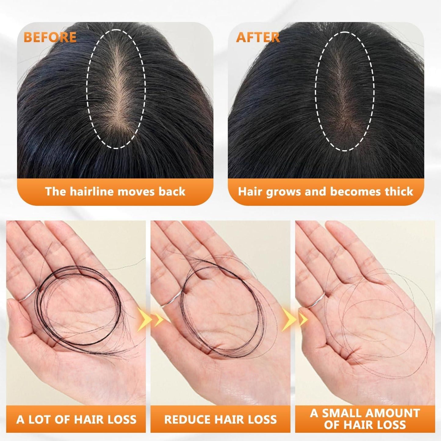 Before and after comparison of hairline movement and hair growth with close-up of hair loss reduction.